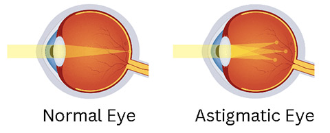 astigmatism