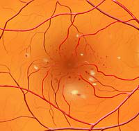 Diabetic Retinopathy