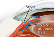 GLAUCOMA