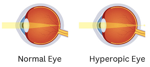 hyperopia