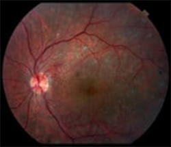 Management of retinal  eye diseases