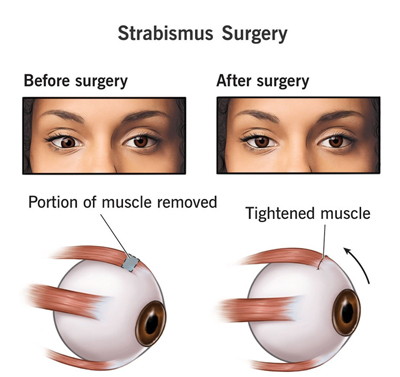 Strabismus Surgery