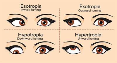 Types of Strabismus