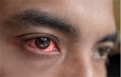 Uveitis and ocular inflammation