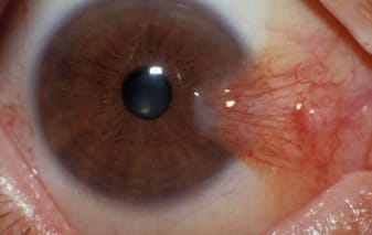 pterygium-img